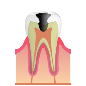 歯髄（歯の神経）まで進行したむし歯