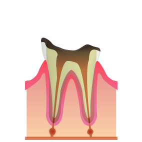 歯が大きく失われた歯